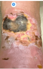 Seven-Day Peel-and-Place NPWT for Leg Wounds: Initial Clinical Experience