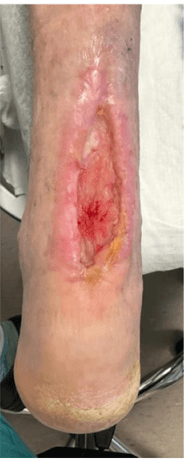 Novel Repair for Recurrent Achilles Tendon Rupture
