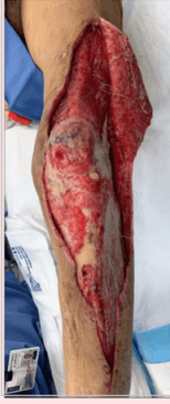 ADM + NPWT for Open Fractures: 7-Case Series