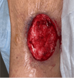 Bioactive Glass Matrix for Complex Leg Wounds: 4-Case Series