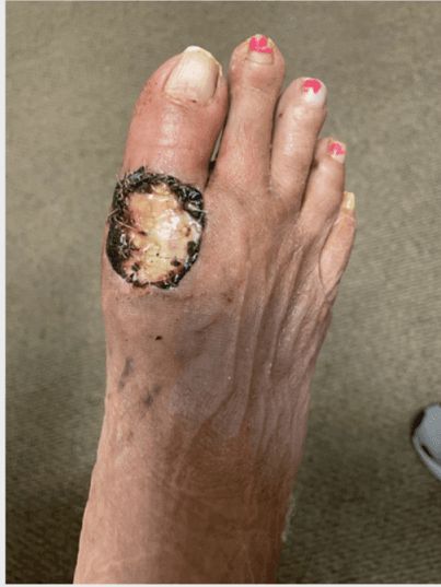 Bioactive Glass Matrix Heals Dorsal Foot Ulcer with Exposed Hardware
