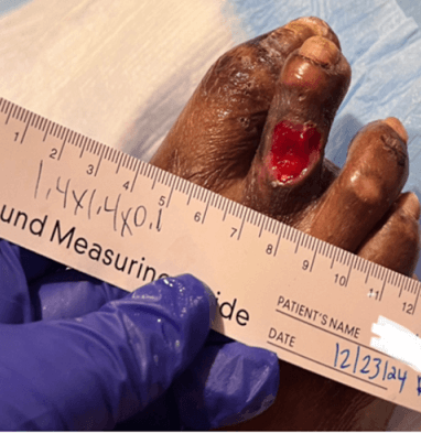 Bioactive Glass Matrix for Pressure Injuries: Early PAR & Closure