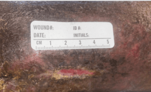 Bioactive Glass Matrix for Recalcitrant Trauma and Amputation Wounds