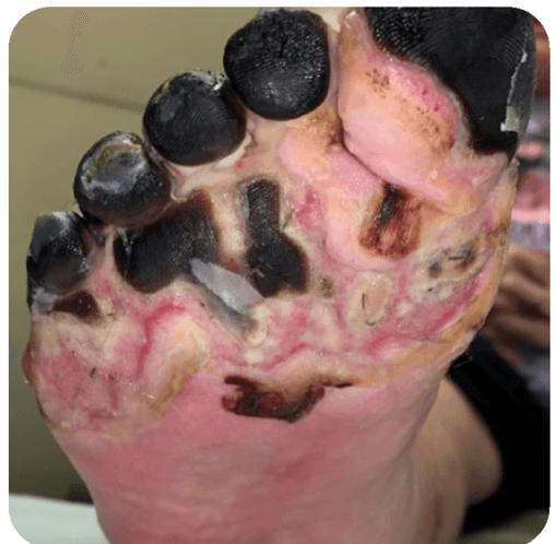 BBSM for Pressor Injuries: Safety, Timing & Outcomes