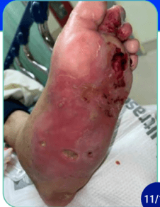 BIOMES Framework for Limb Salvage and CLTI Triage