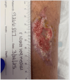 Borate Bioactive Glass Matrix for Stalled Wounds: When to Add It