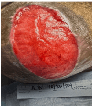 Icelandic Cod Fish Skin Grafts for Complex Surgical Wounds