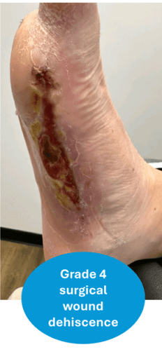 Continuous Topical Oxygen Therapy: 5 Real-World Cases