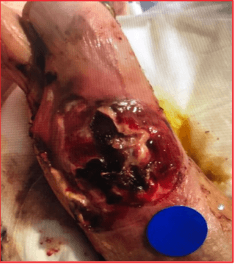 CTPs Equalize Diabetic Wound Outcomes: 138-Patient Real-World Study