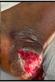 ESWT for Diabetic Foot Ulcers: Faster Healing With Broad-Focused Shockwaves