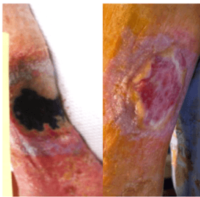Fish Skin Grafts for Post-Radiation Calf Wounds: Limb Salvage Case Study