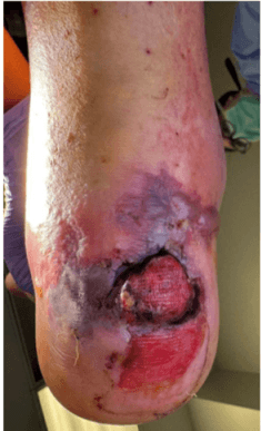 Fish Skin Before STSG: Staged DFU Reconstruction
