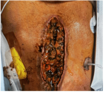 GV/MB PVA & PU Foams for ECF Wounds: Case-Based Protocol