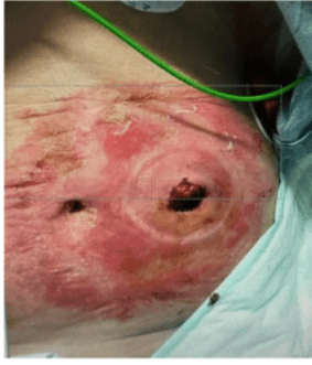 GV/MB Foam for Peristomal Atopic Dermatitis: A Case-Based Guide