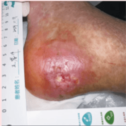 Hydroxyurea-Associated Heel Ulcer in PV and Diabetes: ON101 Case