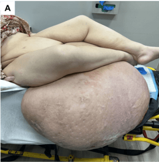 Massive Localized Lymphedema: Panniculectomy Resolves Chronic Wounds