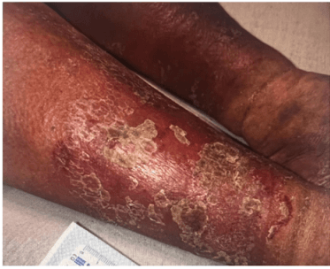 Multilayer Compression Improves Skin Quality in CVI: 10-Patient Series