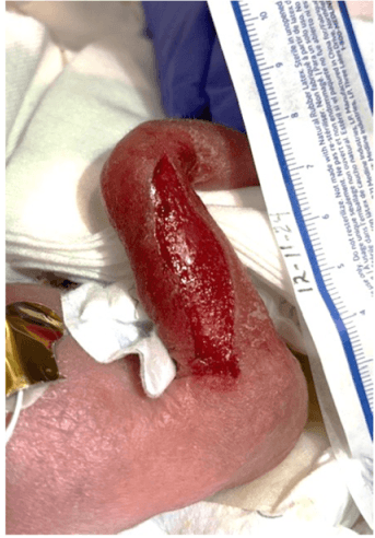Intact Fish Skin Grafts for Neonatal Wounds: Case Series