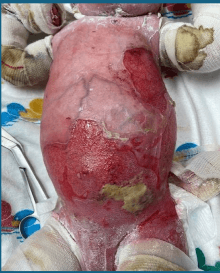 Is Pure Hypochlorous Acid Safe in the NICU?