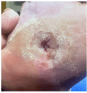 All-in-One NPWT Dressing for Complex Wounds: 3 Case Results