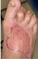 Peel-and-Place NPWT for Lower-Leg Wounds: 12-Patient Case Series