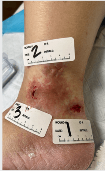Bioactive Glass Matrix for Hydroxyurea Leg Ulcers