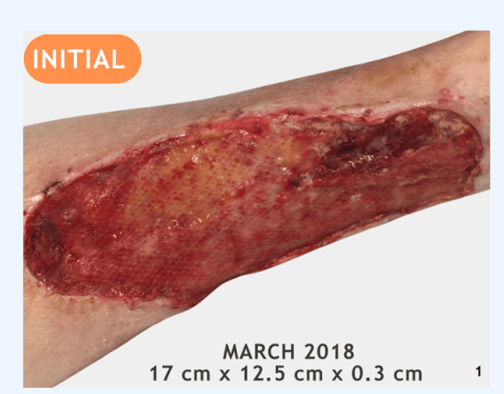 Polycythemia Vera Leg Ulcer: Multimodal Case & Protocol
