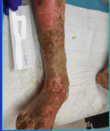 Pediatric Pyoderma Gangrenosum: Multidisciplinary Care Case