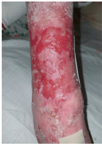 Cutaneous SCC in Epidermolysis Bullosa: Closure with Decellularized Bovine Pericardium