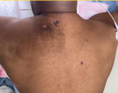 Nonhealing 'Abscess' After I&D? Think Epidermoid Cyst (and Plan Excision)