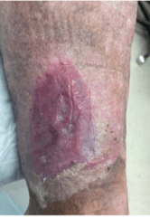 Super Absorbent Dressings + Two-Layer Compression Heal Draining Leg Wounds