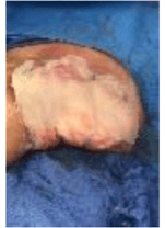 Urinary Bladder Matrix for HS Defects: Outpatient Healing Results