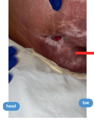 3D Xenograft for Stage 4 Pressure Ulcers: Case Series Outcomes